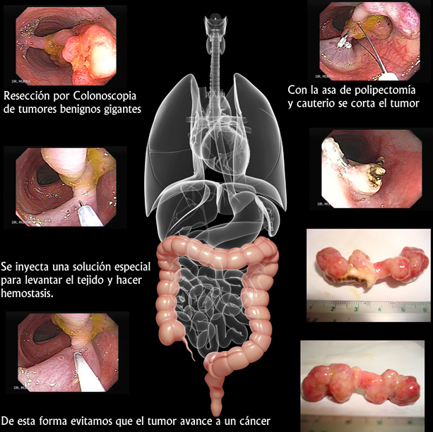 Polipectomia, Colonoscopia El Salvador