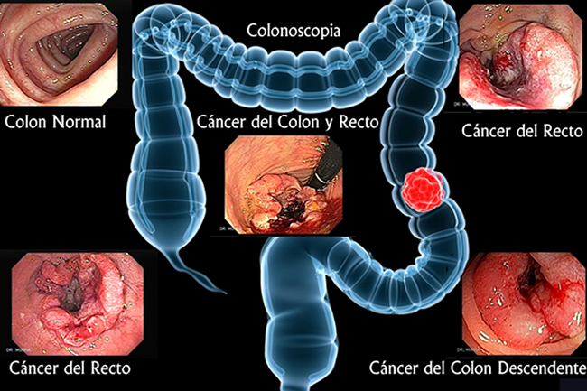 Cancer del colon y recto, Colonoscopia El Salvador